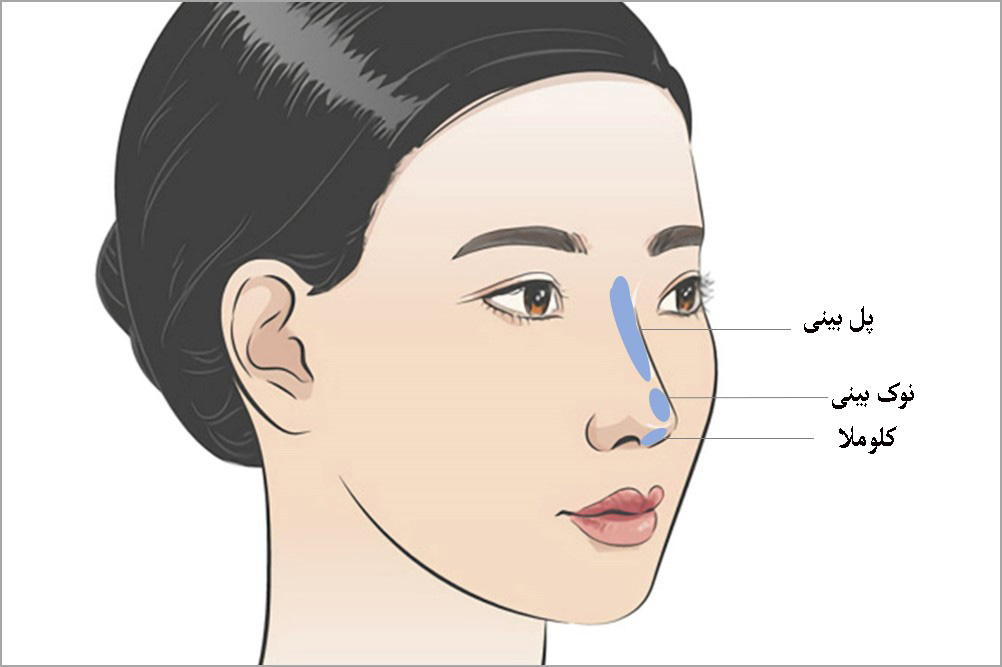 تزریق فیلر بینی استخوانی