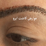 عوارض کاشت ابرو
