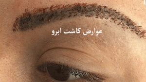 عوارض کاشت ابرو