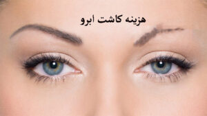 هزینه کاشت ابرو