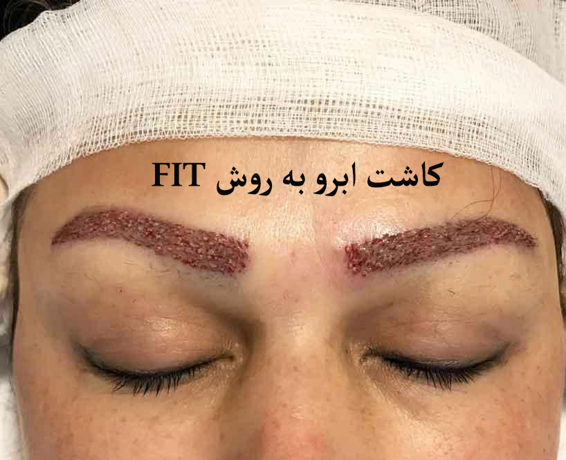 کاشت ابرو به روش FIT