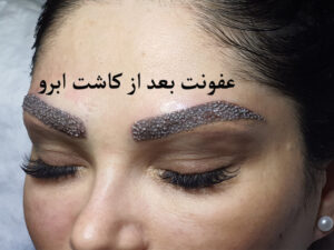 عفونت بعد از کاشت ابرو
