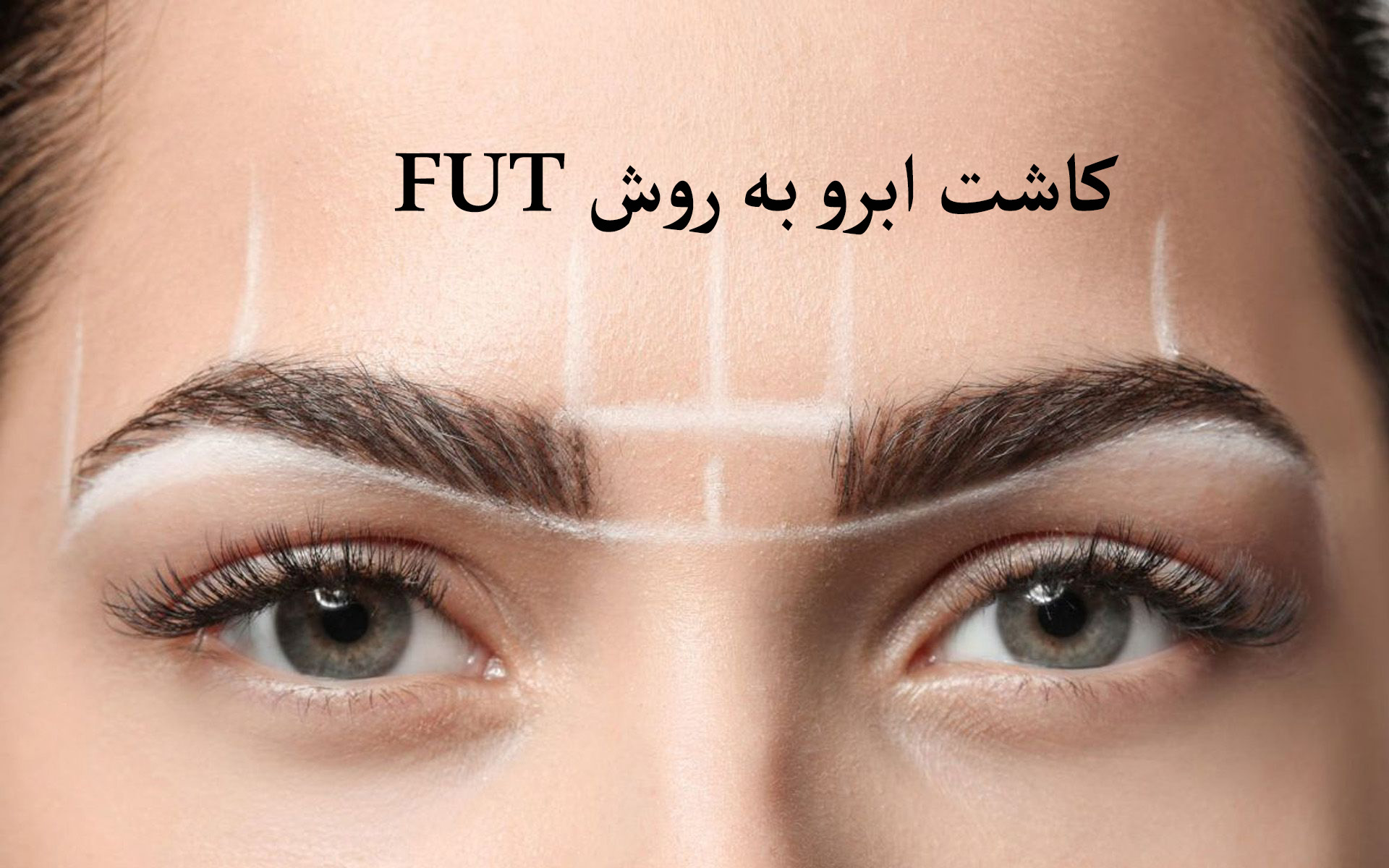 کاشت ابرو به روش FUT