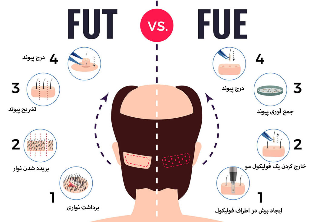 مقایسه کاشت مو با روش FUT و FUE
