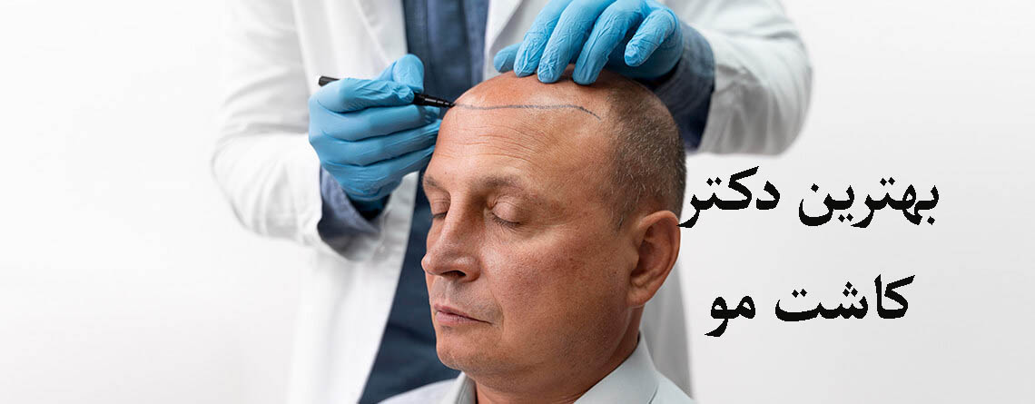 بهترین دکتر کاشت مو